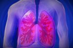 Kasus Tuberkulosis di Indonesia Urutan ke Tiga Dunia, 93 Ribu Kematian per Tahun